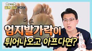 엄지발가락이 휘는 무지 외반증 말끔하게 고치는 방법 - 골통 의사 윤재웅 #23 무지외반증