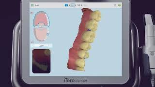 iTero® Scanner Tutorial Scanning and Charting for a Single Unit Prep