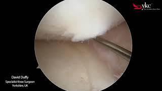 What is a Cartilage Flap? Dave Duffy Explains