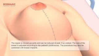 Breast lift Animation - Boerhaave Medical Centre