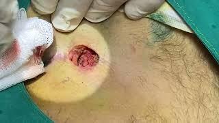 Pilonidal kist operasyonu -kıl dönmesi ameliyat- Cyst dermoid sacral