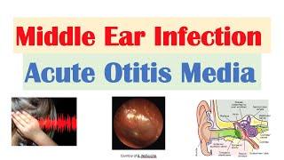 Middle Ear Infection Acute Otitis Media  Causes Symptoms Diagnosis Treatment