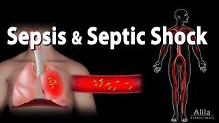 Sepsis and Septic Shock Animation.