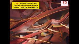 Стентирование сонных артерий как метод эндоваскулярной операции для профилактики инсульта анимация