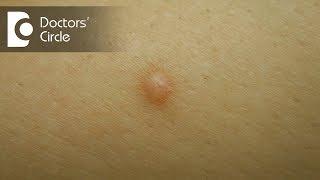 Diagnosis of skin colored lump with brown spot - Dr. Nanda Rajaneesh