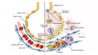 Venous Thromboembolism Evidence pre-COVID and current COVID observations