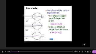 Anisometropia and antimetropia  pupil size and blur circlesemmetrope part 5