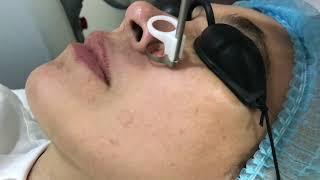 Pore Reduction Treatment by Fotona Starwalker @ Enhanze Clinic Malaysia