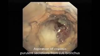 AsvideEsophageal carcinoma with tracheobronchoesophageal fistula due to esophageal stent and...