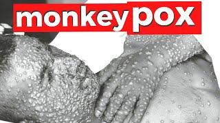 What you need to know about Monkeypox MPX