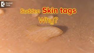 Why do I suddenly have skin tags? Are they dangerous? - Dr. Rasya Dixit