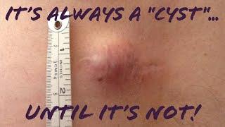 Skin lumpbump? Its NOT always just a cystlipoma Misdiagnosed Skin CancerSarcoma Mimic Cyst