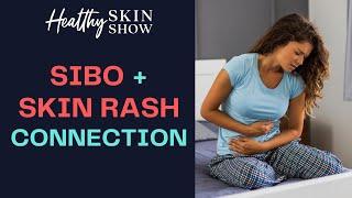 SIBO-Skin Rash Connection  Amy Hollenkamp