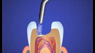 Базовое лечение глубокого кариеса.