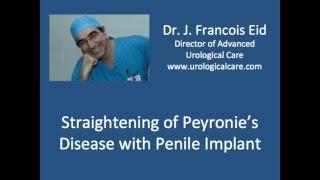 Straightening of Peyronies Disease with Penile Implant