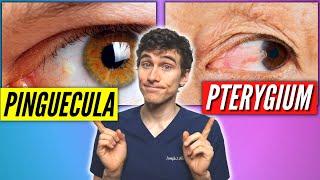 Pinguecula Vs Pterygium Signs Symptoms Treatment