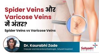 Spider Veins और Varicose Veins में अंतर?  Spider Veins vs Varicose Veins  Dr Kaurabhi Zade