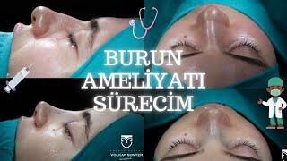 BURUN AMELİYATI ÖNCESİ  SÜRECİ  SONRASI 🩺 TÜM SÜREÇ ⏱️