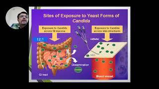 Opportunistic Mycoses I - Candidiasis