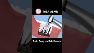 #asmr #tataasmr #toothdecay Pulp Removal ASMR