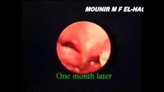 Hysteroscopic view one two & three months after Septum cutting تجويف الرحم بعد قطع الحاجذ الرحمى