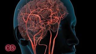 Symptoms of Stroke and Migraine  Cedars-Sinai