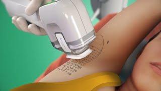 How to treat underarm sweating with miraDry 3D animation