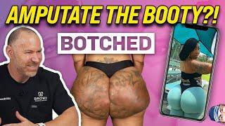 Amputate the Booty?