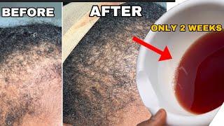SHE USED THIS HAIR GROWTH TREATMENT 3X a WEEK and this HAPPENED Extreme hair growth