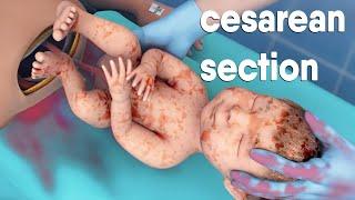 A cesarean section  known as a C-section   is a surgery to deliver a baby via the abdomen