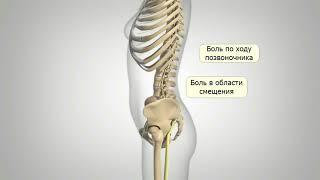 Спондилолистез причины и симптомы