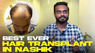 Grade 5 Baldness Gone  7 Months Results After Hair Transplant  Nashik