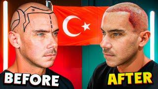 I Got a Hair Transplant in Turkey The Ultimate Guide