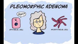 Pleomorphic Adenoma