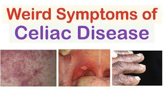 Weird Symptoms of Celiac Disease  Atypical Clinical Features