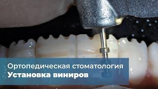 Клиническая история установка виниров