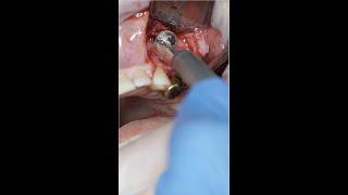 Sinus Infection Surgery
