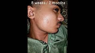 My Minoxidil 5% Journey Shocking Before and After Transformation Revealed #minoxidil5