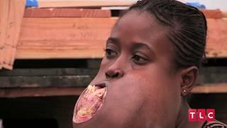 Girl Has Football-Sized Tumour On Her Face Body Bizarre Episode 6