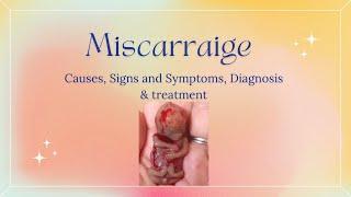 MISCARRIAGE Causes Signs and Symptoms Diagnosis and Treatment.