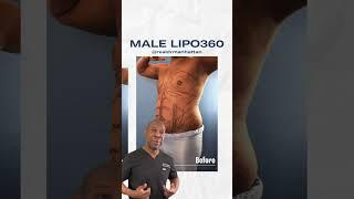 Male Liposuction