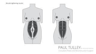 Abdominoplasty  London Tummy Tuck  Mr Paul Tulley