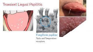 Transient lingual papillitis Lie Bumps - Inflammation of the tongue