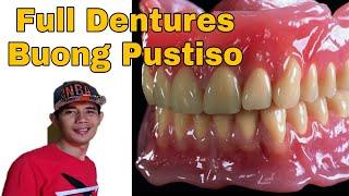 Full Dentures Buong Pustiso Taas at Baba Acrylic Dentures. Dentures in the Philippines.