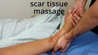 Massage Tutorial Mature scar tissue myofascial release