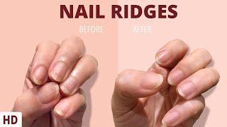 Nail Ridges The Silent Signaling Your Nails Are Trying to Tell You