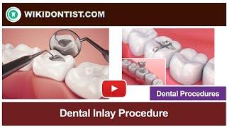 Dental Inlay Procedure  Video by Dr. Thomas Nechupadam