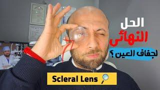 عاجل..هل هو الحل النهائى لمشكلة #جفاف_العين ؟؟ Scleral lens