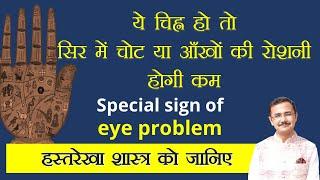 ये चिह्न आपके हाथ में है तो हो सकती है आँखों की रोशनी कम या सिर में लग सकती है चोट Lec. 191