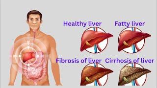 The Silent Clues In Liver Disease - Weight Loss And Muscle Wasting In Liver Disease